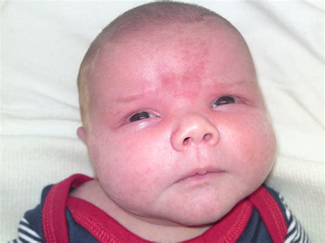 angel kiss mark|Types of birthmarks (birthmark pictures) .